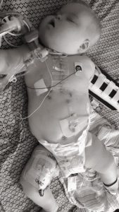 HLHS Post Op Glenn Down Syndrome Trach