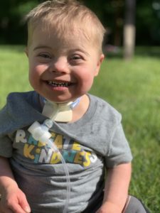 HLHS Down Syndrome Post Glenn Child with Trach